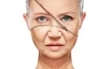 Loss of Collagen