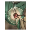 Disposable Incision Protection Sleeve 4